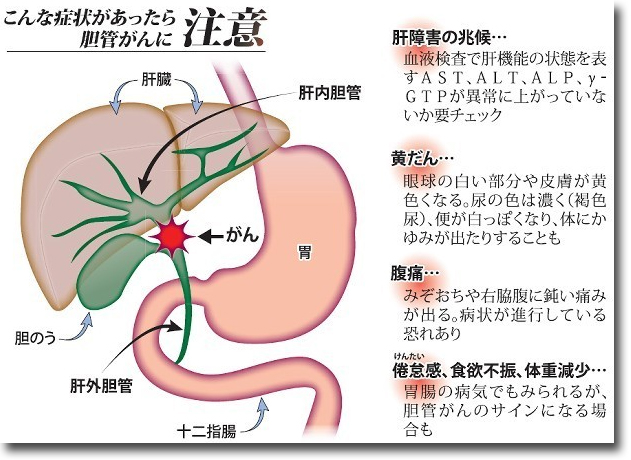 胆管がんの症状は何ですか?