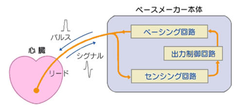 pacemaker02.jpg