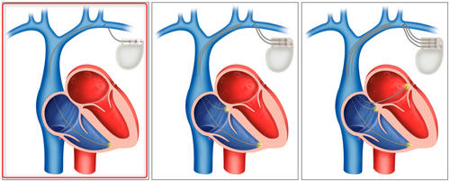 pacemaker05.jpg